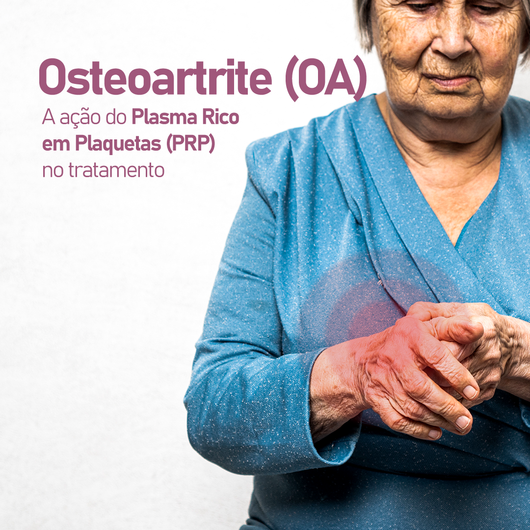 a-acao-do-plasma-rico-em-plaquetas-(prp)-no-tratamento-da-osteoartrite-(oa)