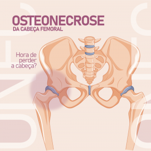 osteonecrose-da-cabeca-femoral-–-hora-de-perder-a-cabeca?